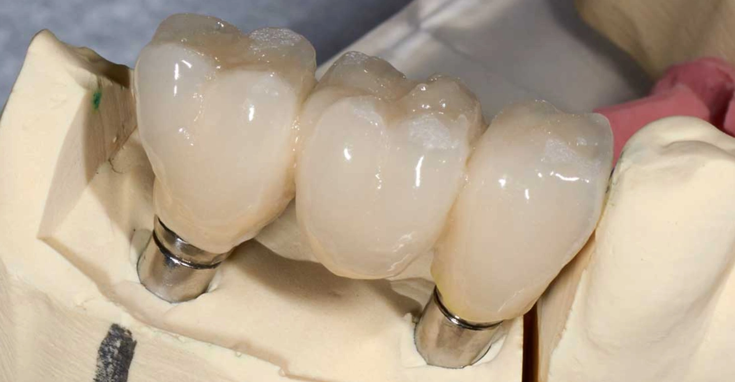 dental implant bridge Inblog